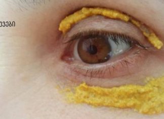 5 დღის განმავლობაში თვალის ირგვლივ კურკუმას ისვამდა! და ასეც მოხდა!