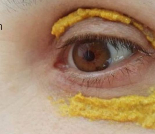 5 დღის განმავლობაში თვალის ირგვლივ კურკუმას ისვამდა! და ასეც მოხდა!