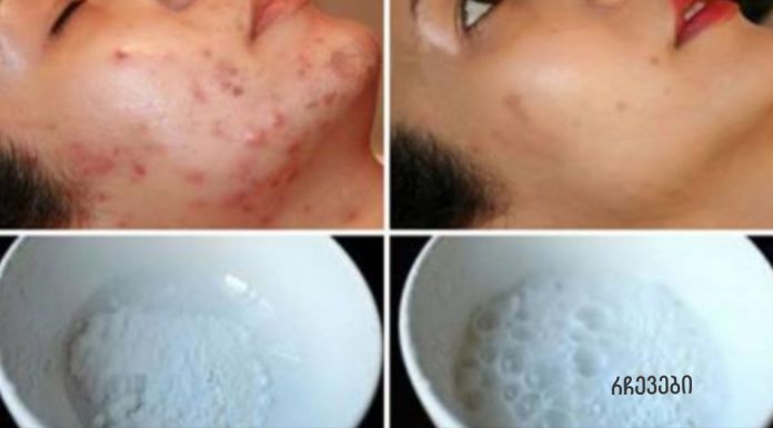 სახის ნიღაბი, რომელიც ჯადოსნურად აშორებს აკნეს, ნაწიბურებს და ნაოჭებს მეორე გამოყენების შემდეგ