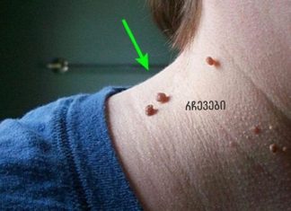 ყველას აქვს ეს მეჭეჭი, მაგრამ არავინ იცის, რა ადვილია მათი მოშორება!