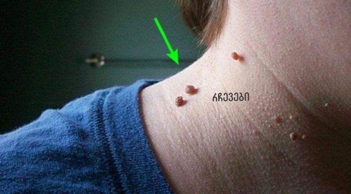 ყველას აქვს ეს მეჭეჭი, მაგრამ არავინ იცის, რა ადვილია მათი მოშორება!