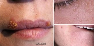 უსწრაფესი გზები აკნეს, ჩაზრდილი თმებისა და კანის 5 სხვა პრობლემის მოსაშორებლად!