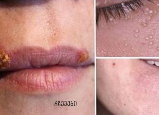 უსწრაფესი გზები აკნეს, ჩაზრდილი თმებისა და კანის 5 სხვა პრობლემის მოსაშორებლად!