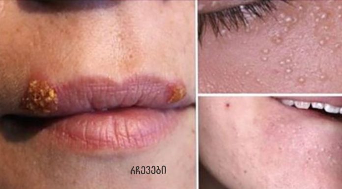 უსწრაფესი გზები აკნეს, ჩაზრდილი თმებისა და კანის 5 სხვა პრობლემის მოსაშორებლად!