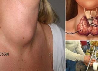 ექიმები ამას არასოდეს გეტყვიან: აი, როგორ განკურნოთ ფარისებრი ჯირკვალი მხოლოდ ერთი ინგრედიენტით!