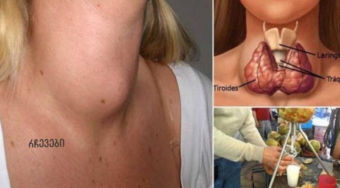 ექიმები ამას არასოდეს გეტყვიან: აი, როგორ განკურნოთ ფარისებრი ჯირკვალი მხოლოდ ერთი ინგრედიენტით!