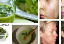 დაემშვიდობეთ მუქ ლაქებს და ჭორფლებს: ეს ინგრედიენტი მოგაშორებთ მათ