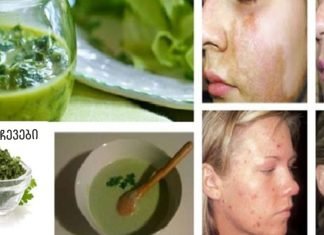 დაემშვიდობეთ მუქ ლაქებს და ჭორფლებს: ეს ინგრედიენტი მოგაშორებთ მათ