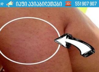 ყველაფერი რაც თქვენ უნდა იცოდეთ მკლავებზე, ბარძაყებსა და დუნდულოებზე გამაღიზიანებელი აკნეების შესახებ