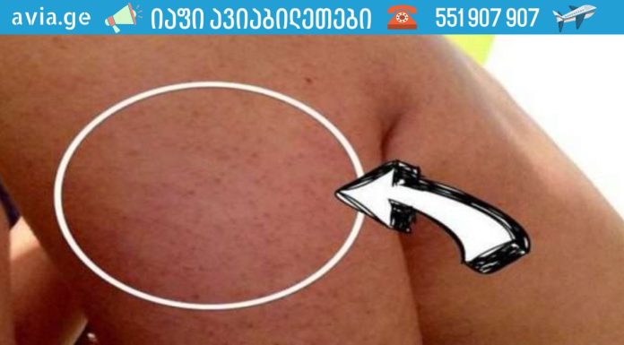 ყველაფერი რაც თქვენ უნდა იცოდეთ მკლავებზე, ბარძაყებსა და დუნდულოებზე გამაღიზიანებელი აკნეების შესახებ