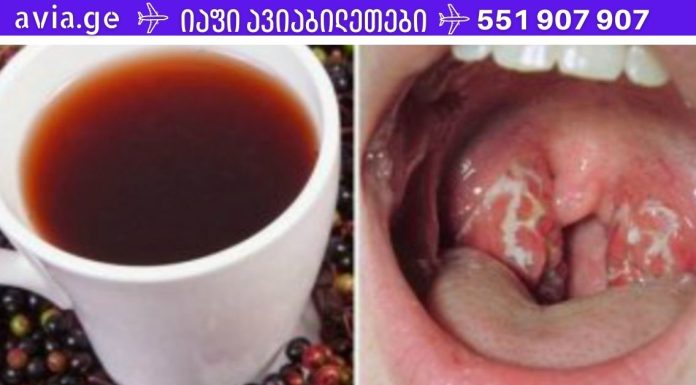 ექიმმა გაუზიარა რჩევა, თუ როგორ უნდა მოვიშოროთ ყელის ინფექცია სულ რაღაც 4 საათში!