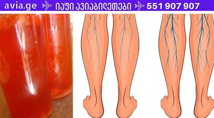 გააუმჯობესე სისხლის მიმოქცევა და კარგად იარეთ ვარიკოზული ვენების დროსაც!! უბრალოდ დალიეთ 1 ჭიქა ამ სასმელიდან დღეში!