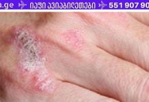 სასწაულმოქმედი მცენარე, რომელიც მკურნალობს ეგზემას, ფსორიაზს, დერმატიტს და კანის სხვა ალერგიულ რეაქციებს