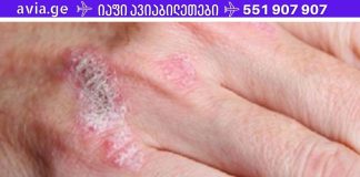 სასწაულმოქმედი მცენარე, რომელიც მკურნალობს ეგზემას, ფსორიაზს, დერმატიტს და კანის სხვა ალერგიულ რეაქციებს