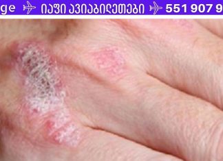 სასწაულმოქმედი მცენარე, რომელიც მკურნალობს ეგზემას, ფსორიაზს, დერმატიტს და კანის სხვა ალერგიულ რეაქციებს