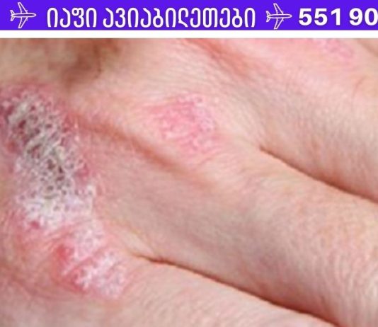 სასწაულმოქმედი მცენარე, რომელიც მკურნალობს ეგზემას, ფსორიაზს, დერმატიტს და კანის სხვა ალერგიულ რეაქციებს