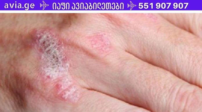 სასწაულმოქმედი მცენარე, რომელიც მკურნალობს ეგზემას, ფსორიაზს, დერმატიტს და კანის სხვა ალერგიულ რეაქციებს