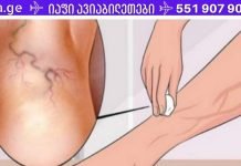მხოლოდ ამ ინგრედიენტის გამოყენებით შეგიძლიათ სამუდამოდ მოიცილოთ ვარიკოზული ვენები!