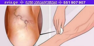 მხოლოდ ამ ინგრედიენტის გამოყენებით შეგიძლიათ სამუდამოდ მოიცილოთ ვარიკოზული ვენები!