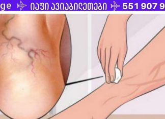 მხოლოდ ამ ინგრედიენტის გამოყენებით შეგიძლიათ სამუდამოდ მოიცილოთ ვარიკოზული ვენები!