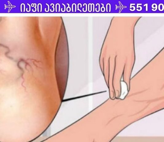 მხოლოდ ამ ინგრედიენტის გამოყენებით შეგიძლიათ სამუდამოდ მოიცილოთ ვარიკოზული ვენები!