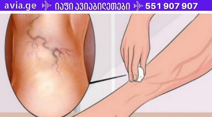 მხოლოდ ამ ინგრედიენტის გამოყენებით შეგიძლიათ სამუდამოდ მოიცილოთ ვარიკოზული ვენები!