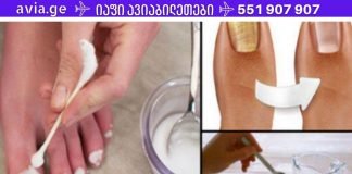 სოკოს ფრჩხილიდან დიდხანს ვერ მოვიშორე, სანამ ეს არ გავაკეთე. შედეგმა ძალიან გამახარა!