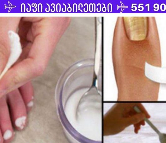 სოკოს ფრჩხილიდან დიდხანს ვერ მოვიშორე, სანამ ეს არ გავაკეთე. შედეგმა ძალიან გამახარა!