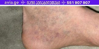 ყველას აქვს ვარიკოზის ეს საშუალება, მაგრამ არავინ იცის ამის შესახებ