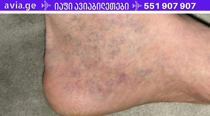 ყველას აქვს ვარიკოზის ეს საშუალება, მაგრამ არავინ იცის ამის შესახებ