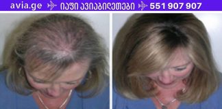 ეს ზეთი საოცარია თმის, წამწამების და წარბების ზრდისთვის.