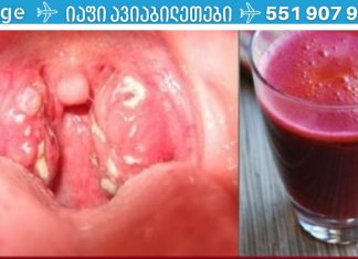 ანგინის მკურნალობა მხოლოდ ერთ დღეში, ანტიბიოტიკების გარეშე!