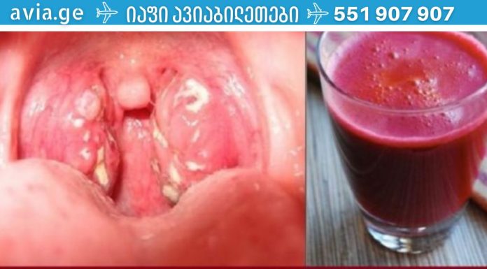 ანგინის მკურნალობა მხოლოდ ერთ დღეში, ანტიბიოტიკების გარეშე!