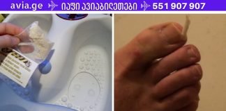 ბაბუის რჩევა ჩაზრდილი ფრჩხილის სამკურნალოდ. ერთხელ და სამუდამოდ მოიშორეთ ეს პრობლემა!