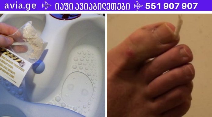 ბაბუის რჩევა ჩაზრდილი ფრჩხილის სამკურნალოდ. ერთხელ და სამუდამოდ მოიშორეთ ეს პრობლემა!