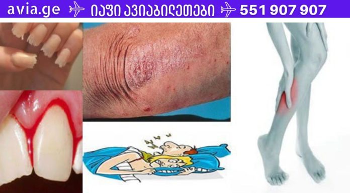 როგორ უნდა მიხვდეთ რომ სხეულს რომელიმე ვიტამინი აკლია? 10 მნიშვნელოვანი ნიშანი, რომელსაც არ შეიძლება უგულებელყო!