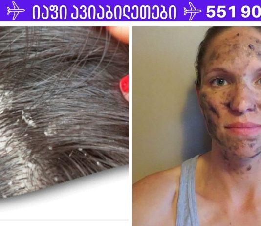 ეს აბები არის ყველა პირველადი დახმარების ნაკრები და ისინი შესანიშნავია აკნეს ,ქერტლის და უამრავი დაავადების სამკურნალოდ.