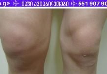 სითხე მუხლის სახსარში? იხილეთ მისგან თავის დაღწევის უმარტივესი გზა!