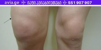 სითხე მუხლის სახსარში? იხილეთ მისგან თავის დაღწევის უმარტივესი გზა!