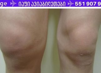 სითხე მუხლის სახსარში? იხილეთ მისგან თავის დაღწევის უმარტივესი გზა!