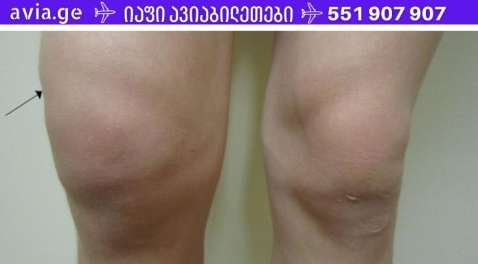 სითხე მუხლის სახსარში? იხილეთ მისგან თავის დაღწევის უმარტივესი გზა!