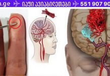 ყველამ უნდა დაუთმოს დრო ამ სტატიის წასაკითხად, რადგან არასოდეს იცი, ვისი ცხოვრება შეიძლება შენზე იყოს დამოკიდებული ერთ წუთში.ინსულტის შემთხვევაში, ნემსი გადაარჩენს თქვენს სიცოცხლეს! ნახეთ, როგორ გაუწიოთ პირველადი დახმარება .