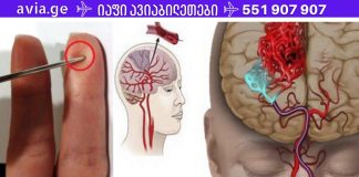 ყველამ უნდა დაუთმოს დრო ამ სტატიის წასაკითხად, რადგან არასოდეს იცი, ვისი ცხოვრება შეიძლება შენზე იყოს დამოკიდებული ერთ წუთში.ინსულტის შემთხვევაში, ნემსი გადაარჩენს თქვენს სიცოცხლეს! ნახეთ, როგორ გაუწიოთ პირველადი დახმარება .