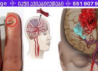 ყველამ უნდა დაუთმოს დრო ამ სტატიის წასაკითხად, რადგან არასოდეს იცი, ვისი ცხოვრება შეიძლება შენზე იყოს დამოკიდებული ერთ წუთში.ინსულტის შემთხვევაში, ნემსი გადაარჩენს თქვენს სიცოცხლეს! ნახეთ, როგორ გაუწიოთ პირველადი დახმარება .