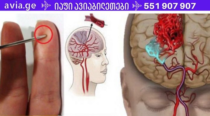 ყველამ უნდა დაუთმოს დრო ამ სტატიის წასაკითხად, რადგან არასოდეს იცი, ვისი ცხოვრება შეიძლება შენზე იყოს დამოკიდებული ერთ წუთში.ინსულტის შემთხვევაში, ნემსი გადაარჩენს თქვენს სიცოცხლეს! ნახეთ, როგორ გაუწიოთ პირველადი დახმარება .