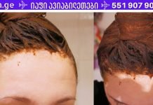 მაშინაც კი, თუ წამლები უძლურია, ეს ხალხური საშუალება ხელს შეუწყობს თმის ცვენის შეჩერებას!