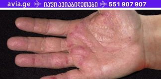 ორგანიზმის ვერაგი დაავადების პირველი სიმპტომები ხელებზე ჩნდება! ყველაზე ცუდი რაც შეგიძლია გააკეთო არის მათი იგნორირება.