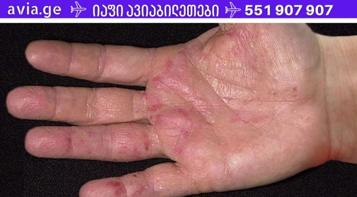 ორგანიზმის ვერაგი დაავადების პირველი სიმპტომები ხელებზე ჩნდება! ყველაზე ცუდი რაც შეგიძლია გააკეთო არის მათი იგნორირება.