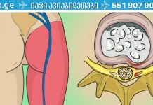 არსებობს 1 ვარჯიში, რომელიც ნამდვილად ხსნის წელის ტკივილს
