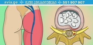 არსებობს 1 ვარჯიში, რომელიც ნამდვილად ხსნის წელის ტკივილს